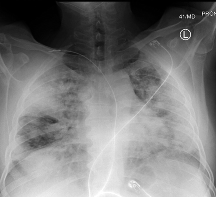 Time course of lung changes in a 59-year-old man with COVID-19 pneumonia evaluated at chest radiography and CT over a 2-month period, which was complicated by development of a pneumothorax. (a–c) AP chest radiographs obtained at hospital admission (a), 4 days later (b), and 1 month later (c) show a peripheral patchy opacity in the left mid lung (oval in a) at the initial assessment, with substantial progression of lung disease on day 4 (b), with development of multiple bilateral peripheral areas of consolidation. The radiograph obtained 1 month later (c) shows interval improvement of the bilateral areas of consolidation and an increase in reticular opacities (dashed arrows in c), with the development of bronchial dilatation (solid arrow in c). Note that at this time the patient had undergone tracheostomy. (d, e) Axial (d) and coronal (e) contrast-enhanced chest CT images, obtained at the same time as c for worsening shortness of breath, show diffuse GGOs associated with superimposed interlobular reticulations, resulting in a crazy-paving pattern (dashed black arrows) and bronchial dilatation (black solid arrows in e). The findings were complicated by the presence of a moderate-sized anterior pneumothorax (white arrows), which was not well appreciated on the plain radiograph (c).