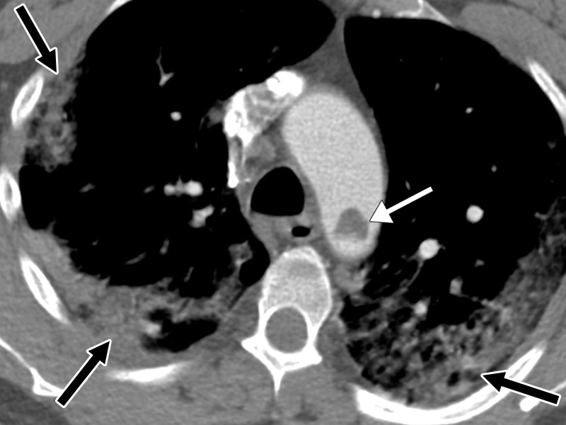 Central and peripheral arterial thrombosis in a severely ill 46-year-old man with COVID-19 in the ICU. (a, b) Axial (a) and sagittal (b) chest CT angiographic images show bibasilar areas of consolidation (black arrows in a), indicative of COVID-19 pneumonia, and a central aortic thrombosis with a thrombus attached to the wall of the aortic arch (white arrow in a and b). (c–f) Sagittal (c), coronal (d), and axial (e, f) CT angiographic images show a large thrombus extending from the abdominal aorta into the superior mesenteric artery origin (arrow in c), which resulted in bowel ischemia, evidenced by thickening of the watershed splenic flexure of the large bowel (arrow in d). Note the multifocal bilateral wedge-shaped renal cortical infarcts (arrows in e). Note also a nonocclusive thrombus in the left profunda femoris artery (white arrow in f), indicative of a concurrent presence of a peripheral thrombosis. There is normal opacification of the patent right profunda femoris artery (black arrow in f). This case demonstrates multifocal multisystem manifestations of COVID-19 complicated by coagulopathy that resulted in injury to various organs and systems. It is an example of the need for increased awareness among radiologists to thoroughly evaluate all covered anatomy for COVID-related complications.