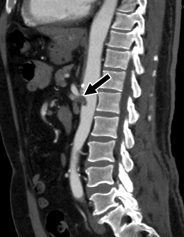 Central and peripheral arterial thrombosis in a severely ill 46-year-old man with COVID-19 in the ICU. (a, b) Axial (a) and sagittal (b) chest CT angiographic images show bibasilar areas of consolidation (black arrows in a), indicative of COVID-19 pneumonia, and a central aortic thrombosis with a thrombus attached to the wall of the aortic arch (white arrow in a and b). (c–f) Sagittal (c), coronal (d), and axial (e, f) CT angiographic images show a large thrombus extending from the abdominal aorta into the superior mesenteric artery origin (arrow in c), which resulted in bowel ischemia, evidenced by thickening of the watershed splenic flexure of the large bowel (arrow in d). Note the multifocal bilateral wedge-shaped renal cortical infarcts (arrows in e). Note also a nonocclusive thrombus in the left profunda femoris artery (white arrow in f), indicative of a concurrent presence of a peripheral thrombosis. There is normal opacification of the patent right profunda femoris artery (black arrow in f). This case demonstrates multifocal multisystem manifestations of COVID-19 complicated by coagulopathy that resulted in injury to various organs and systems. It is an example of the need for increased awareness among radiologists to thoroughly evaluate all covered anatomy for COVID-related complications.