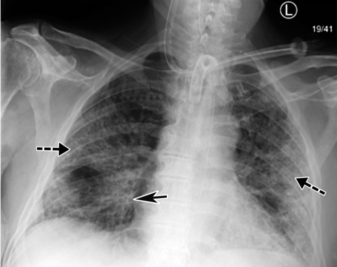 Time course of lung changes in a 59-year-old man with COVID-19 pneumonia evaluated at chest radiography and CT over a 2-month period, which was complicated by development of a pneumothorax. (a–c) AP chest radiographs obtained at hospital admission (a), 4 days later (b), and 1 month later (c) show a peripheral patchy opacity in the left mid lung (oval in a) at the initial assessment, with substantial progression of lung disease on day 4 (b), with development of multiple bilateral peripheral areas of consolidation. The radiograph obtained 1 month later (c) shows interval improvement of the bilateral areas of consolidation and an increase in reticular opacities (dashed arrows in c), with the development of bronchial dilatation (solid arrow in c). Note that at this time the patient had undergone tracheostomy. (d, e) Axial (d) and coronal (e) contrast-enhanced chest CT images, obtained at the same time as c for worsening shortness of breath, show diffuse GGOs associated with superimposed interlobular reticulations, resulting in a crazy-paving pattern (dashed black arrows) and bronchial dilatation (black solid arrows in e). The findings were complicated by the presence of a moderate-sized anterior pneumothorax (white arrows), which was not well appreciated on the plain radiograph (c).