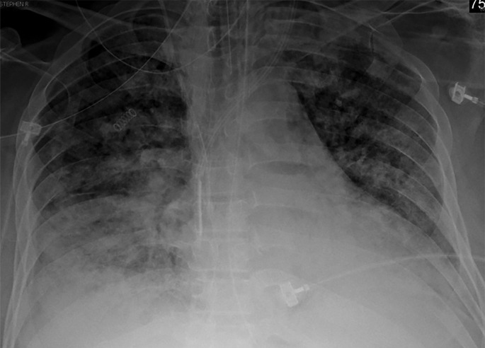 Longitudinal assessment of COVID-19 pneumonia progression in a 56-year-old man who presented to the emergency department with dyspnea and dry cough. (a) AP chest radiograph obtained at hospital admission at the time of symptom onset shows bilateral pulmonary opacities (arrows) at the periphery of the right mid lung and at the left lung base. (b) AP chest radiograph obtained on day 8 of hospitalization shows progression of multifocal opacities bilaterally, which now involve more than two lobes, and interval development of bibasilar consolidations. These findings correspond to a higher severity score and carry a worse prognosis. In addition, there is mild pulmonary edema, suggestive of fluid overload. Note that the patient had undergone intubation. (c) AP chest radiograph obtained on day 14 of hospitalization shows progression of the multifocal bilateral peripheral opacities.