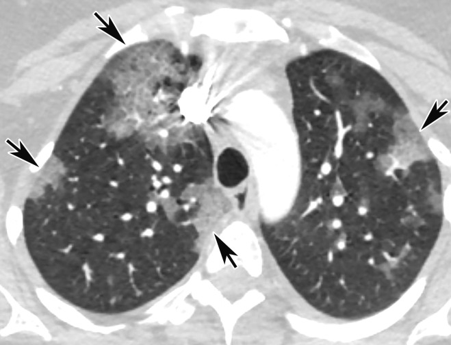 Temporal pulmonary changes of COVID-19 pneumonia at CT in a 36-year-old woman. (a–c) Axial contrast-enhanced CT images obtained at hospital admission show patchy bilateral GGOs and interlobular septal thickening (black arrows), with lower lobe predominance and subpleural involvement. Note also some immediate subpleural sparing of the GGOs (white arrows in b and c). (d–f) Follow-up corresponding axial contrast-enhanced CT images show evolving consolidative changes with volume loss, architectural distortion (ovals), and bronchiectasis (arrows in e and f).