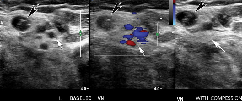 Superficial vein thrombosis in a 72-year-old woman hospitalized with COVID-19. Transverse gray-scale (left) and color Doppler (middle) US images without compression and gray-scale US image with compression (right) show an occlusive thrombus in the dilated basilic vein (black arrows). Note the absence of flow within the vein on the color Doppler US image (middle) and noncompressibility of the vein (left). The brachial veins (white arrows) are compressible (right) and demonstrate patency on the color Doppler US image (middle).