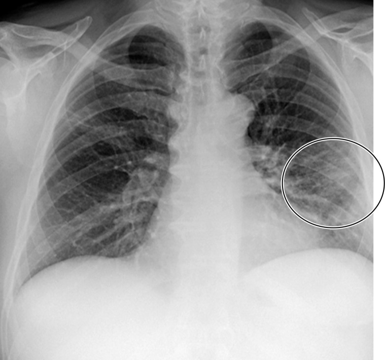 Time course of lung changes in a 59-year-old man with COVID-19 pneumonia evaluated at chest radiography and CT over a 2-month period, which was complicated by development of a pneumothorax. (a–c) AP chest radiographs obtained at hospital admission (a), 4 days later (b), and 1 month later (c) show a peripheral patchy opacity in the left mid lung (oval in a) at the initial assessment, with substantial progression of lung disease on day 4 (b), with development of multiple bilateral peripheral areas of consolidation. The radiograph obtained 1 month later (c) shows interval improvement of the bilateral areas of consolidation and an increase in reticular opacities (dashed arrows in c), with the development of bronchial dilatation (solid arrow in c). Note that at this time the patient had undergone tracheostomy. (d, e) Axial (d) and coronal (e) contrast-enhanced chest CT images, obtained at the same time as c for worsening shortness of breath, show diffuse GGOs associated with superimposed interlobular reticulations, resulting in a crazy-paving pattern (dashed black arrows) and bronchial dilatation (black solid arrows in e). The findings were complicated by the presence of a moderate-sized anterior pneumothorax (white arrows), which was not well appreciated on the plain radiograph (c).