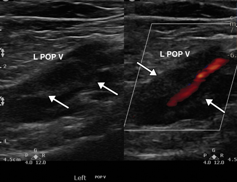 Partially occlusive thrombus in the left popliteal vein (L POP V) in a critically ill 64-year-old man with COVID-19 who acutely developed left leg swelling. Laboratory test results confirmed elevated d-dimer levels. Gray-scale (left) and power Doppler (right) US images show a dilated left popliteal vein with echogenic thrombus (arrows) within, best visualized on the gray-scale US image. Power Doppler image US (right) shows absence of flow within the distended vein except for a small amount of flow within the lumen of the vessel, indicative of a partially occlusive thrombus.