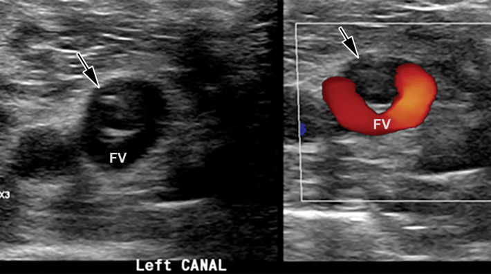 Saddle embolus in a 52-year-old man who presented to the emergency department with hypoxia and tachycardia and received positive test results for COVID-19. (a–c) Axial chest CT angiographic images show a saddle embolus (arrows in a), extending into the lobar and segmental pulmonary artery branches bilaterally, and associated dilatation of the right ventricle, suggestive of right heart strain (arrow in b). Patchy peripheral GGOs on the right and a nodular area of consolidation (arrows in c) on the left are typical findings of COVID-19 pneumonia. (d) Gray-scale (left) and corresponding color Doppler (right) US images of the left femoral vein (FV) obtained in the transverse plane show a partially occlusive thrombus (arrows). The vein was not compressible at manual compression (not shown).