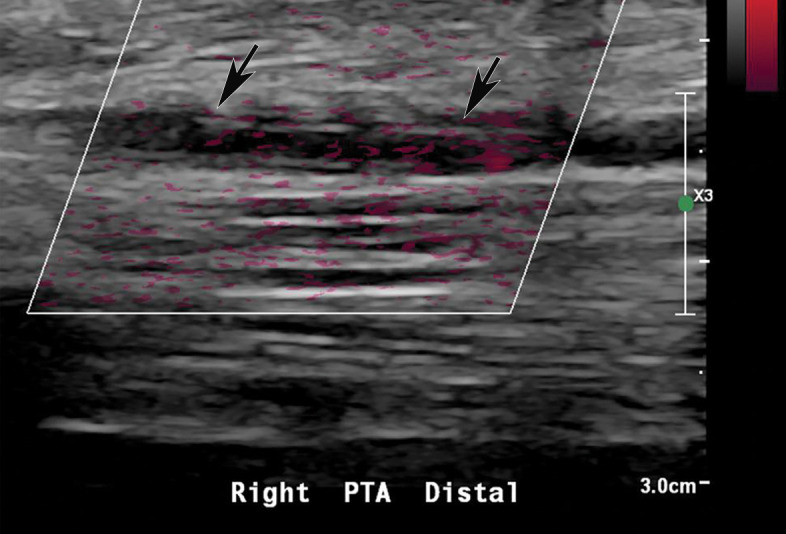 Popliteal and posterior tibial artery thrombosis in a 58-year-old woman with COVID-19 in the ICU. (a, b) Sagittal color (a) and spectral (b) Doppler US images show an echogenic heterogeneous thrombus (white arrows) distending the right popliteal artery. The characteristic knocking or “stump-thump” waveform with absence of diastolic flow (black arrows in b) and low amplitude (yellow circle in b) imply the presence of occlusion just distal to the area of interrogation. (c) Sagittal power Doppler US image shows no flow in the occluded right posterior tibial artery (black arrows). (d) Corresponding sagittal CT angiographic reconstruction shows abrupt cutoff of the popliteal artery by a thrombus (solid arrow). Note the opacified popliteal artery (Rt POP A) proximal to the thrombus (dashed arrow). The patient also had a liver infarct and bowel ischemia (not shown).