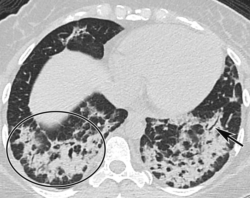 Temporal pulmonary changes of COVID-19 pneumonia at CT in a 36-year-old woman. (a–c) Axial contrast-enhanced CT images obtained at hospital admission show patchy bilateral GGOs and interlobular septal thickening (black arrows), with lower lobe predominance and subpleural involvement. Note also some immediate subpleural sparing of the GGOs (white arrows in b and c). (d–f) Follow-up corresponding axial contrast-enhanced CT images show evolving consolidative changes with volume loss, architectural distortion (ovals), and bronchiectasis (arrows in e and f).