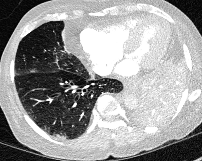 COVID-19 pneumonia complicated by mucus plugging and lung collapse in a 78-year-old man who presented with shortness of breath and suspicion of PE. Axial (a) and coronal (b, c) chest CT angiographic images show patchy GGOs (arrowheads in b) on the right and left lung opacification with volume loss in the left upper lobe due to atelectasis. Adjacent atelectasis and pneumonia in the left upper and lower lobes are evidenced by enhancement of the atelectatic lung (black arrow in c) and absence of enhancement within the pneumonic consolidation (white arrow in c). Atelectasis was caused by the presence of thick mucus that resulted in bronchial obstruction and subsequent collapse.