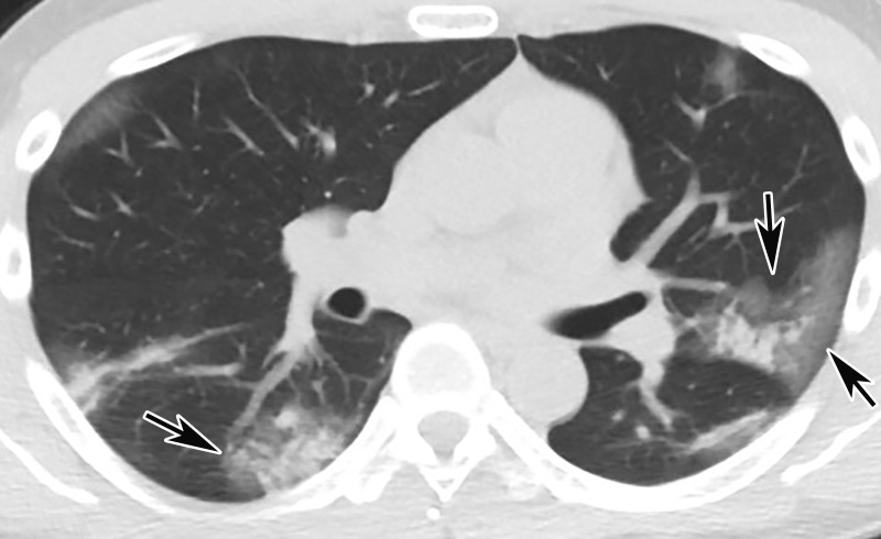 Halo sign in a 19-year-old man who presented with persistent fever and cough for 9 days and with positive test results for COVID-19. Axial nonenhanced CT chest image shows multifocal bilateral areas of mixed GGOs, with central nodular masslike opacities surrounded by ground-glass attenuation (arrows), a characteristic finding of a halo sign. Note that the opacities are located at the lung periphery.