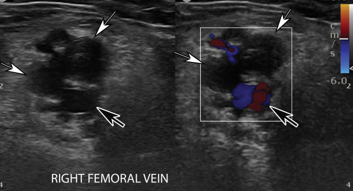 Occlusive DVT of the femoral vein in an 88-year-old man who had been hospitalized with COVID-19. Gray-scale (left) and color Doppler (right) US images obtained in the transverse plane show dilated femoral veins (white arrows), with internal heterogeneous echogenic material and absence of flow on the color Doppler US image, findings compatible with occlusion. The veins were noncompressible (not shown). Note that the femoral artery is filled with color, indicative of patency (black arrows).