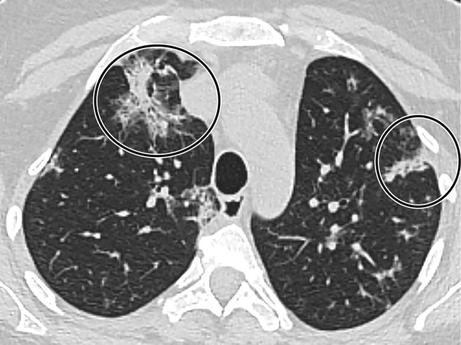 Temporal pulmonary changes of COVID-19 pneumonia at CT in a 36-year-old woman. (a–c) Axial contrast-enhanced CT images obtained at hospital admission show patchy bilateral GGOs and interlobular septal thickening (black arrows), with lower lobe predominance and subpleural involvement. Note also some immediate subpleural sparing of the GGOs (white arrows in b and c). (d–f) Follow-up corresponding axial contrast-enhanced CT images show evolving consolidative changes with volume loss, architectural distortion (ovals), and bronchiectasis (arrows in e and f).