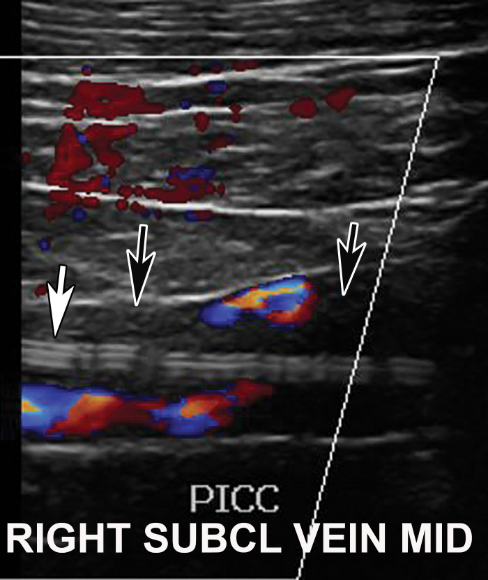 DVT associated with a peripherally inserted central catheter (PICC) line in a 54-year-old man with COVID-19. Sagittal color Doppler US image shows an echogenic thrombus (black arrows) in the right subclavian vein, associated with the PICC line (white arrow).