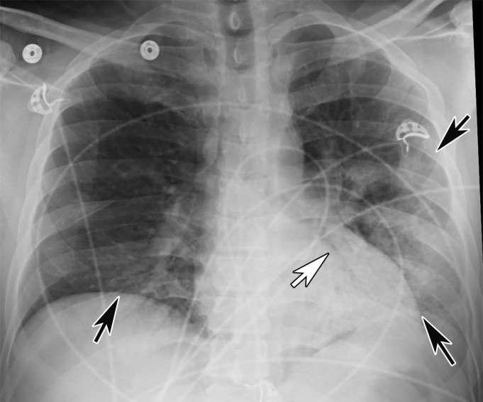 Interstitial edema and pleural thickening in a 40-year-old man with COVID-19 who presented to the emergency department with hypoxia and dyspnea. (a) Gray-scale lung US image obtained in the longitudinal plane over the left lower lobe shows multiple (more than three) vertical echogenic bands (white arrows) extending from the pleural surface to the deeper portions of the lung, consistent with B-line artifacts, indicating subpleural interstitial edema. Note that the lung pleura is thickened and irregular (black arrow). (b) Corresponding AP chest radiograph shows multifocal bilateral patchy peripheral opacities (black arrows), with an area of consolidation (white arrow) in the left lower lobe with air bronchograms, which is indicative of organizing pneumonia.