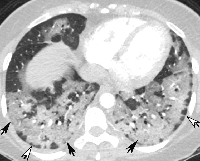 Temporal pulmonary changes of COVID-19 pneumonia at CT in a 36-year-old woman. (a–c) Axial contrast-enhanced CT images obtained at hospital admission show patchy bilateral GGOs and interlobular septal thickening (black arrows), with lower lobe predominance and subpleural involvement. Note also some immediate subpleural sparing of the GGOs (white arrows in b and c). (d–f) Follow-up corresponding axial contrast-enhanced CT images show evolving consolidative changes with volume loss, architectural distortion (ovals), and bronchiectasis (arrows in e and f).