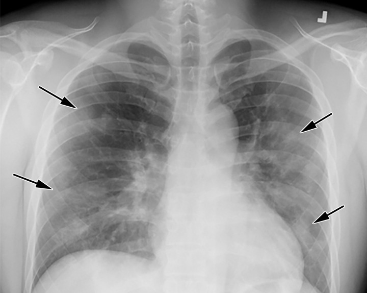 COVID-19 progression over 4 days in a 28-year-old man. (a) Posteroranterior chest radiograph shows bilateral multiple peripheral and lower lobe GGOs (arrows). (b) Axial non–contrast material–enhanced CT image obtained 4 days later shows progression of the typical appearance of COVID pneumonia, manifesting with bilateral GGOs (arrowheads), peripheral on the right and diffuse on the left. In addition, there is rapid worsening of the lung pneumonia, with development of bilateral lower lobe airspace consolidations (arrows).