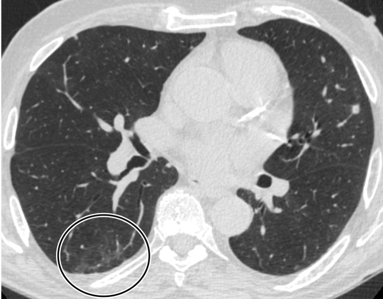 Reverse halo sign in a 76-year-old man with COVID-19 and a history of pancreatic cancer. (a, b) Axial (a) and coronal (b) contrast-enhanced CT images show a nodular opacity (black arrow) in the right lower lobe, with central GGOs and peripheral solid consolidation, consistent with a reverse halo sign. Note the subtle bilateral peripheral GGOs (white arrows). (c) Axial contrast-enhanced CT image obtained 3 weeks after diagnosis shows subsequent resolution of the reverse halo sign, with vague residual opacity (circle).