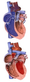 D-loop transposition of great arteries: (top) at birth; (bottom) after arterial switch
