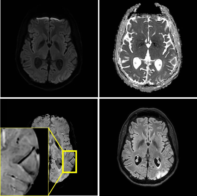 MRI at 3T performed three weeks later, because of a second stroke-like event. A similar lesion in the gyri of the left occipital lobe is present. Signal abnormalities in the previously affected area nearly normalized, but microhemorrhages persisted