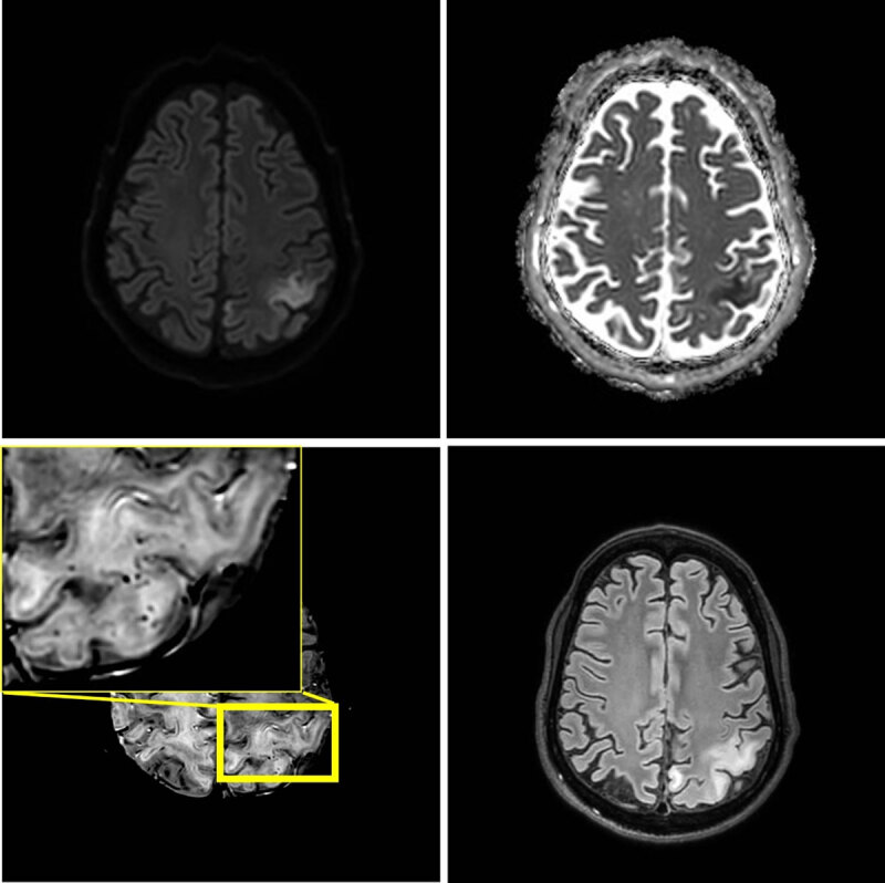 One month later, seven weeks after the initial episode, a third stroke-like event occurred. MRI shows a new area of edema in the left parietal lobe including the postcentral gyrus. The new lesion shows diffusion restriction and juxtacortical microhemorrhages