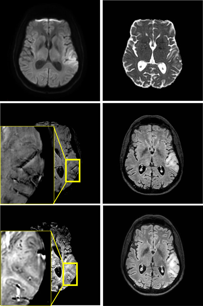 Edema in the left temporoparietal operculum without reduced diffusivity on MRI at 3T at first presentation (4 upper images). No microhemorrhages are found on the first scan, but they are present in juxtacortical location at one-week follow-up (2 lower images)