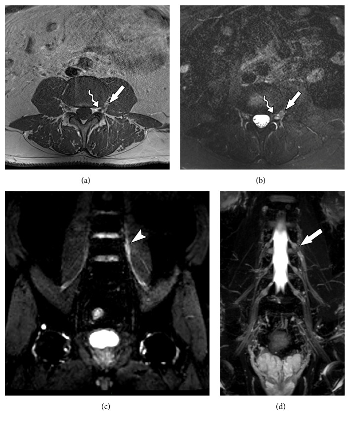 Demystifying Mr Neurography Of The Lumbosacral Plexus From Protocols