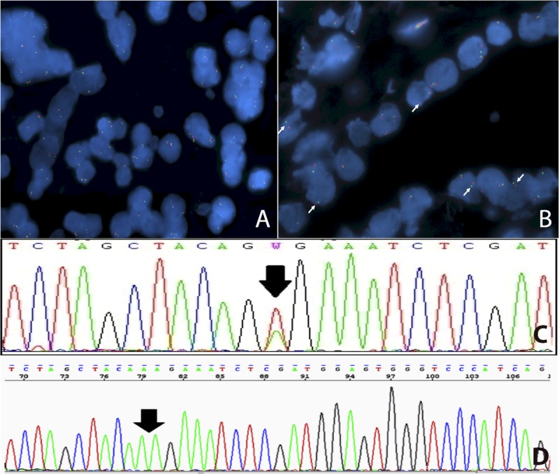 KIAA1549: BRAF Gene Fusion and FGFR1 Hotspot Mutations Are Prognostic ...