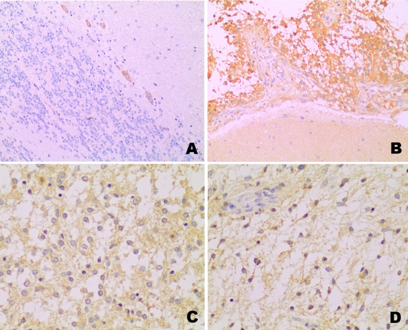 KIAA1549: BRAF Gene Fusion and FGFR1 Hotspot Mutations Are Prognostic ...