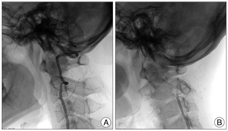 Rotational Vertebral Artery Compression : Bow Hunter's Syndrome - PMC