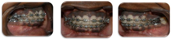 Figure 13: Completion of Orthodontic Treatment.