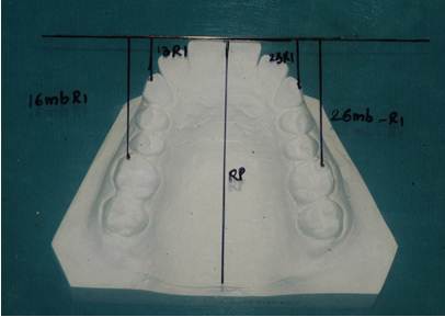 Figure 15: Pre-distraction Model Analysis.