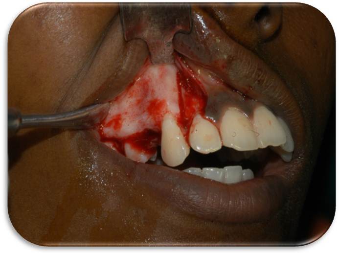 Figure 5: Osteotomy Cuts.