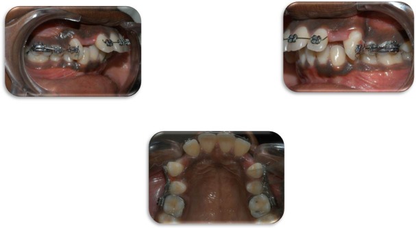 Figure 12: Consolidation with Orthodontic Appliance.