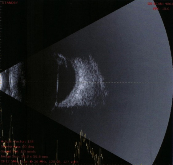 Persistent hyaloid artery with an aberrant peripheral retinal ...