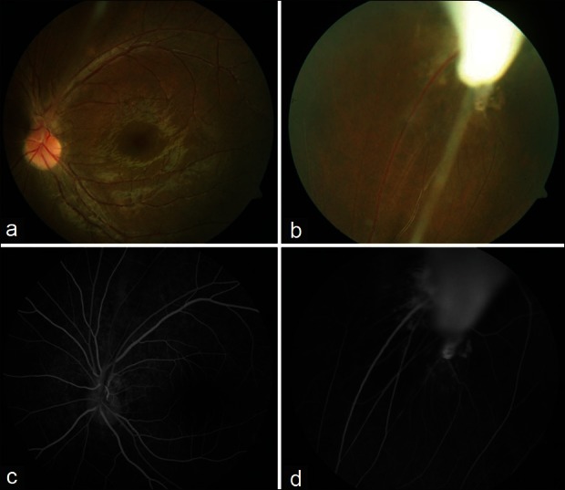 Persistent hyaloid artery with an aberrant peripheral retinal ...