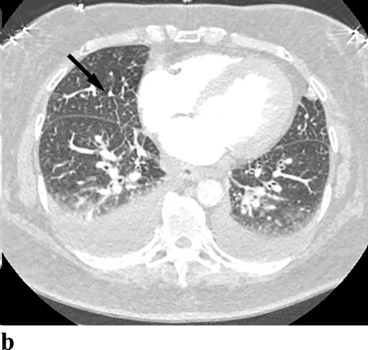 (a,b) - Pulmonary edema: A 67 year old female with cardiac history notable for congestive heart failure, coronary artery disease, aortic stenosis and past myocardial infarction presented with dizziness. CT performed to rule out pulmonary embolism demonstrates bilateral pleural effusions and pulmonary interstitial edema (arrows).