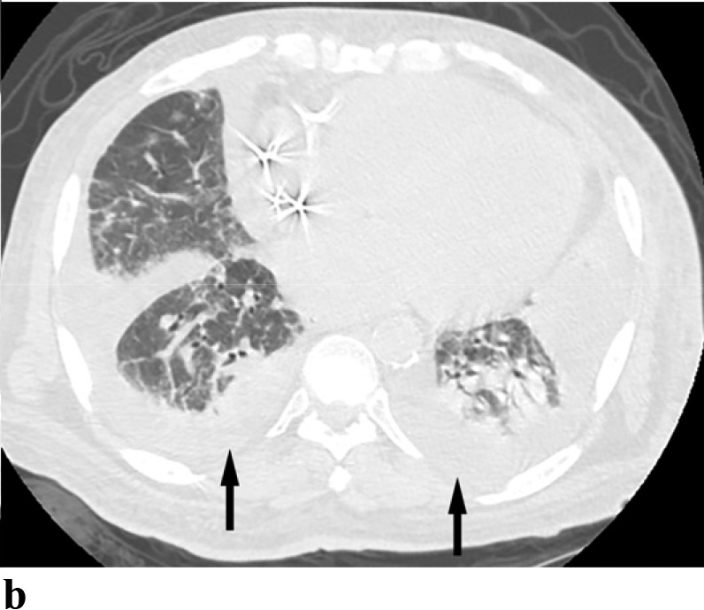 (a-c) - COVID with coexisting heart failure: A 69 year old male presented with acute on chronic CHF with ejection fraction of 28%. The patient tested positive for COVID-19. Note patchy peripherally distributed GGO’s (arrowheads). The patient also has moderate bilateral pleural effusions (arrows).