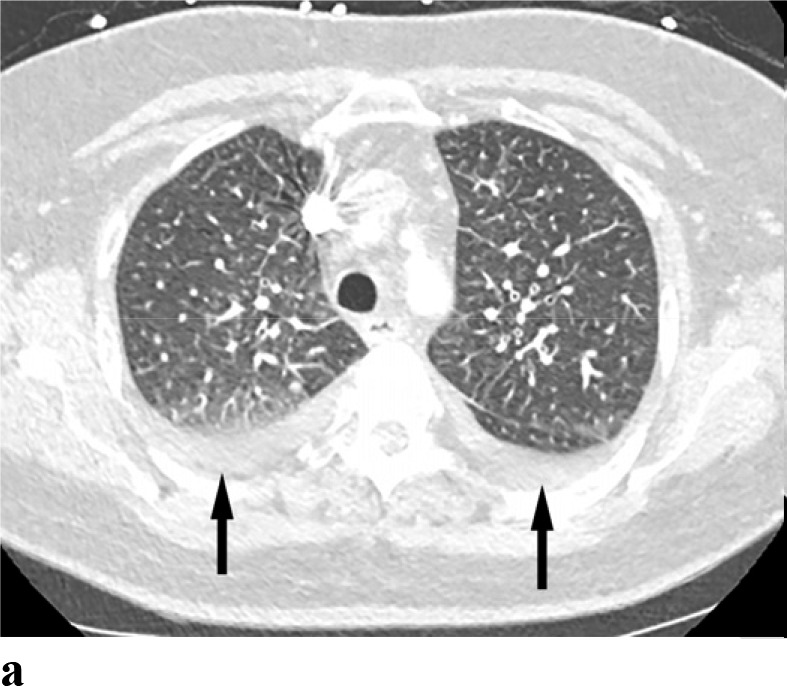 (a,b) - Pulmonary edema: A 67 year old female with cardiac history notable for congestive heart failure, coronary artery disease, aortic stenosis and past myocardial infarction presented with dizziness. CT performed to rule out pulmonary embolism demonstrates bilateral pleural effusions and pulmonary interstitial edema (arrows).