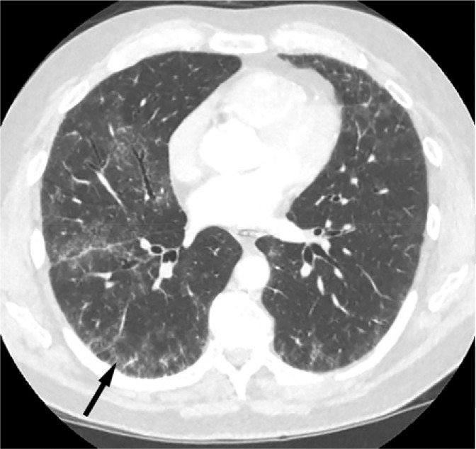 Nonspecific interstitial pneumonitis: CT shows subpleural interstitial prominence, most predominant in both lower lobes with associated traction bronchiectasis.