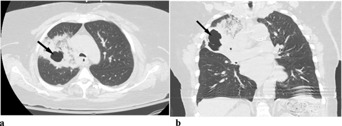 (a,b) Bacterial pneumonia: A 64 year old female patient presented with significant shortness of breath. The patient was noted to have bacteremia secondary to pseudomonas. Chest CT shows mixed ground glass opacities and consolidation in the right upper lobe with cavitation (arrows).