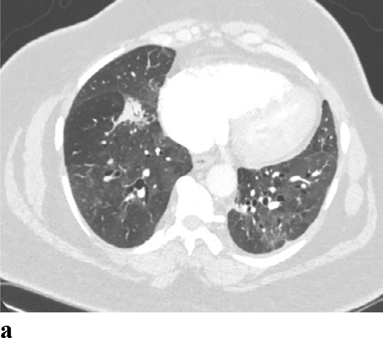 (a,b) - Drug induced pneumonitis: 61 year old woman with history of stage IIIA non-small cell lung cancer s/p chemoradiation followed by immunotherapy (durvalumab). Her course was complicated by pneumonitis. The patient improved with steroid treatment.