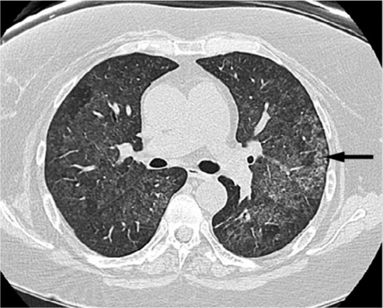 (a, b) Diffuse alveolar hemorrhage: 47 yr old female w recurring hemoptysis. CT demonstrates widespread ground glass opacities in both lungs (arrow).