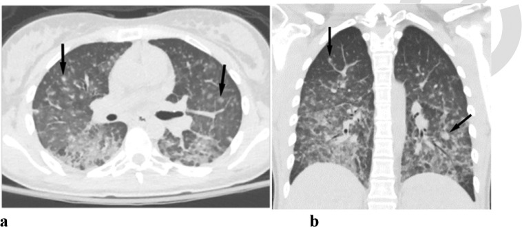 (a,b) CMV pneumonia: 31 year old female with a past medical history of Type 1 Diabetes mellitus complicated by end stage renal disease, s/p kidney/pancreas transplant presents with 2 days of right lower quadrant abdominal pain associated with nausea/vomiting. Upon further work-up, patient was found to have CMV viremia. CT demonstrates diffuse randomly distributed small pulmonary nodules (arrows), many of them are ill-defined and distributed in the secondary pulmonary lobules, and also in the perilymphatic regions.