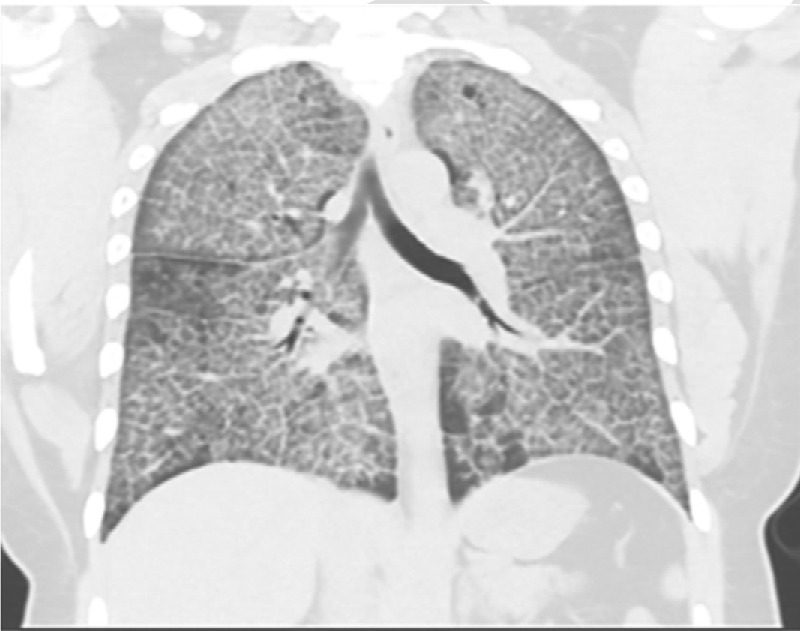 (a, b) Pulmonary alveolar proteinosis: 41 year old female who approximately 6 months ago presented with shortness of breath and a dry cough. A CT scan showed extensive crazy paving appearance of the lung parenchyma, ground-glass opacities with septal thickening. The patient underwent bronchoscopy with biopsy. Findings of bronchoscopy were consistent with pulmonary alveolar proteinosis.