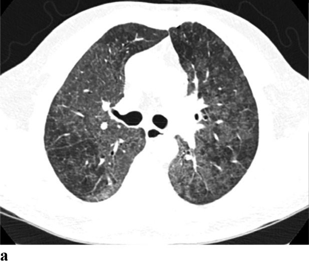 (a,b) - Hypersensitivity pneumonitis: 28-year-old female presented with chronic cough associated with shortness of breath dyspnea on exertion. She lives at home where her sister has an African gray parrot. CT shows widespread ground-glass opacities. There is hypoattenuation and hypovascularity of scattered secondary lobules (head cheese sign). Her clinical symptoms worsened and she was diagnosed with hypersensitivity pneumonitis.