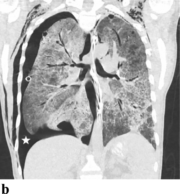 (a,b) - Pneumocystis carinii pneumonia: 32 yr old male with AIDS and a CD4 of 7 presented with respiratory arrest. CT demonstrates a moderate right pneumothorax (asterisk) and widespread ground glass and air space opacities.