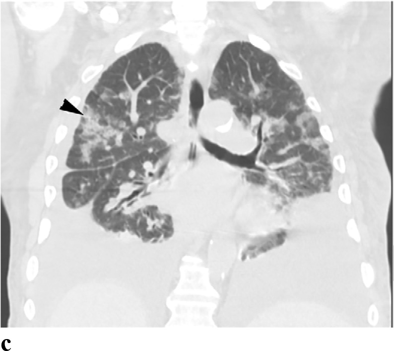 (a-c) - COVID with coexisting heart failure: A 69 year old male presented with acute on chronic CHF with ejection fraction of 28%. The patient tested positive for COVID-19. Note patchy peripherally distributed GGO’s (arrowheads). The patient also has moderate bilateral pleural effusions (arrows).