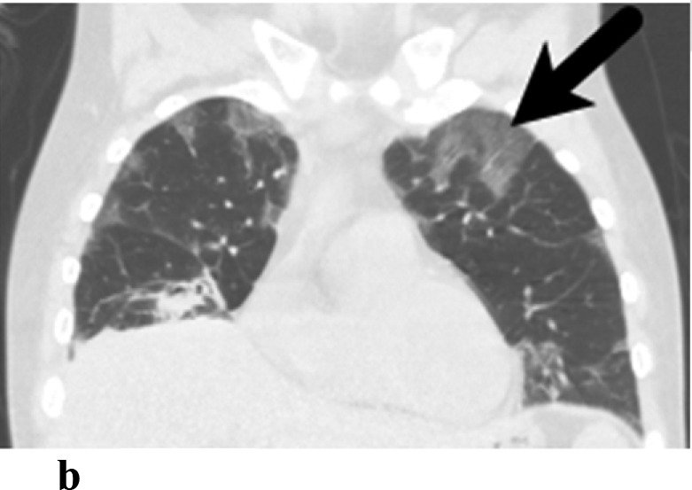 (a,b) - Organizing Pneumonia: 43-year-old, Caucasian male with a history of follicular lymphoma, status post chemotherapy. He was admitted for respiratory failure. Lung biopsy yielded organizing pneumonia. He did well on steroids and was discharged.