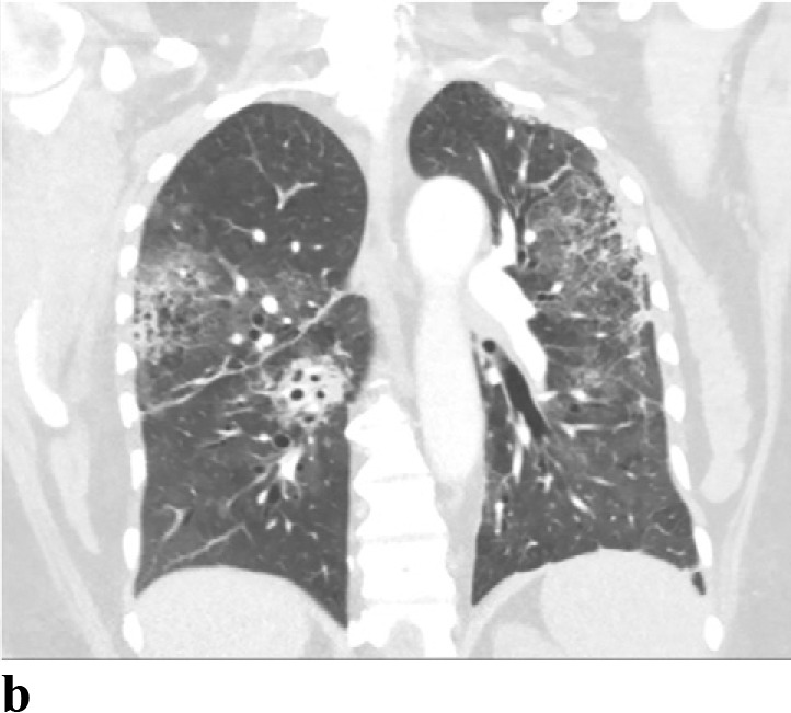 (a,b) - Drug induced pneumonitis: 61 year old woman with history of stage IIIA non-small cell lung cancer s/p chemoradiation followed by immunotherapy (durvalumab). Her course was complicated by pneumonitis. The patient improved with steroid treatment.