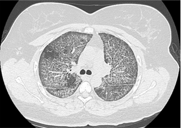 (a, b) Pulmonary alveolar proteinosis: 41 year old female who approximately 6 months ago presented with shortness of breath and a dry cough. A CT scan showed extensive crazy paving appearance of the lung parenchyma, ground-glass opacities with septal thickening. The patient underwent bronchoscopy with biopsy. Findings of bronchoscopy were consistent with pulmonary alveolar proteinosis.